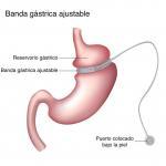 banda gastrica ajustable