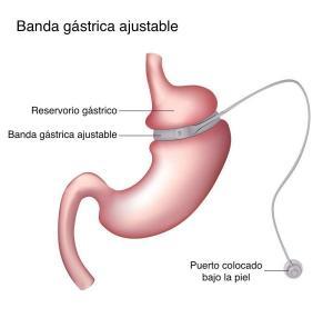 banda gastrica ajustable