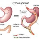 bypass gastrico madrid mipsalud