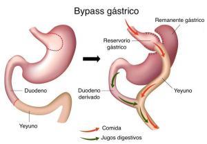 bypass gastrico mipsalud