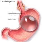balón intagastrico