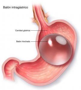 balón intagastrico