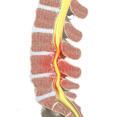 estenosis de canal medular